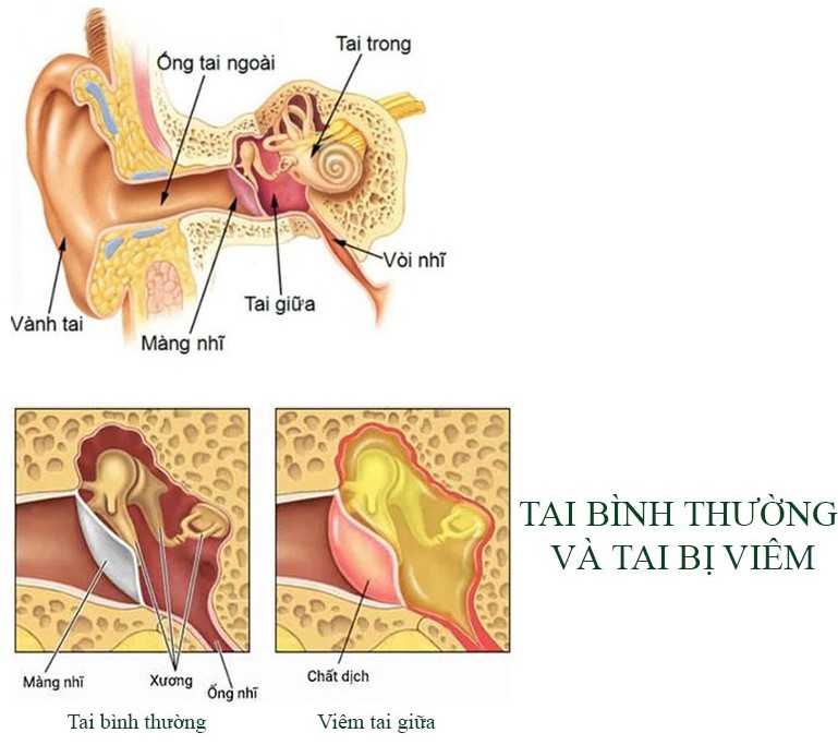Viêm tai giữa ở trẻ em (AOM) là vấn đề nhiễm trùng do vi khuẩn hoặc virut ở tai giữa, thường đi cùng với nhiễm trùng đường hô hấp trên. Các triệu chứng bao gồm đau tai, thường có triệu chứng toàn thân (ví dụ như sốt, buồn nôn, nôn mửa, tiêu chảy), đặc biệt ở trẻ nhỏ. Chẩn đoán dựa trên soi tai.