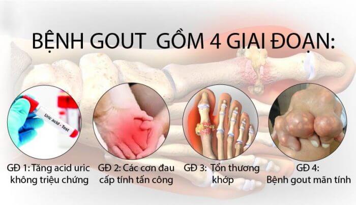 Bệnh Gout hoặc là bệnh Gút ( từ gút bắt nguồn từ tiếng Pháp goutte /ɡut/), còn gọi là thống phong, một loại viêm khớp, do rối loạn chuyển hóa nhân purin trong thận, khiến thận không thể lọc axit uric từ trong máu thường gặp ở nam giới.