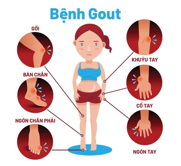 Bệnh Gout hoặc là bệnh Gút ( từ gút bắt nguồn từ tiếng Pháp goutte /ɡut/), còn gọi là thống phong, một loại viêm khớp, do rối loạn chuyển hóa nhân purin trong thận, khiến thận không thể lọc axit uric từ trong máu thường gặp ở nam giới.