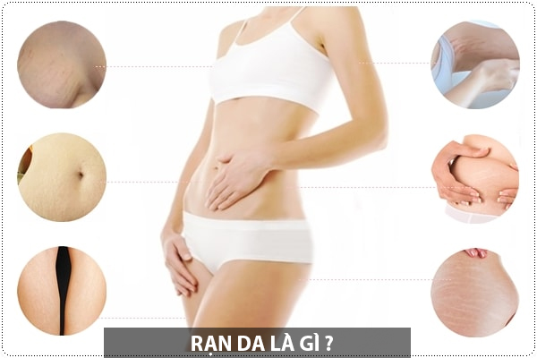 Rạn da (các đường vân) là một dạng sẹo, hình thành khi da bị co giãn nhanh, làm đứt gãy collagen và elastin- các cấu trúc nâng đỡ da. Chúng chỉ những vệt lõm vào thường xuất hiện trên bụng, ngực, hông, mông hoặc những vị trí khác trên cơ thể. Thường gặp ở phụ nữ mang thai, đặc biệt là trong ba tháng cuối.